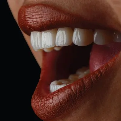 Porcelain-veneers